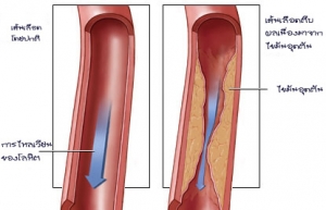 เส้นเลือดอุดตัน